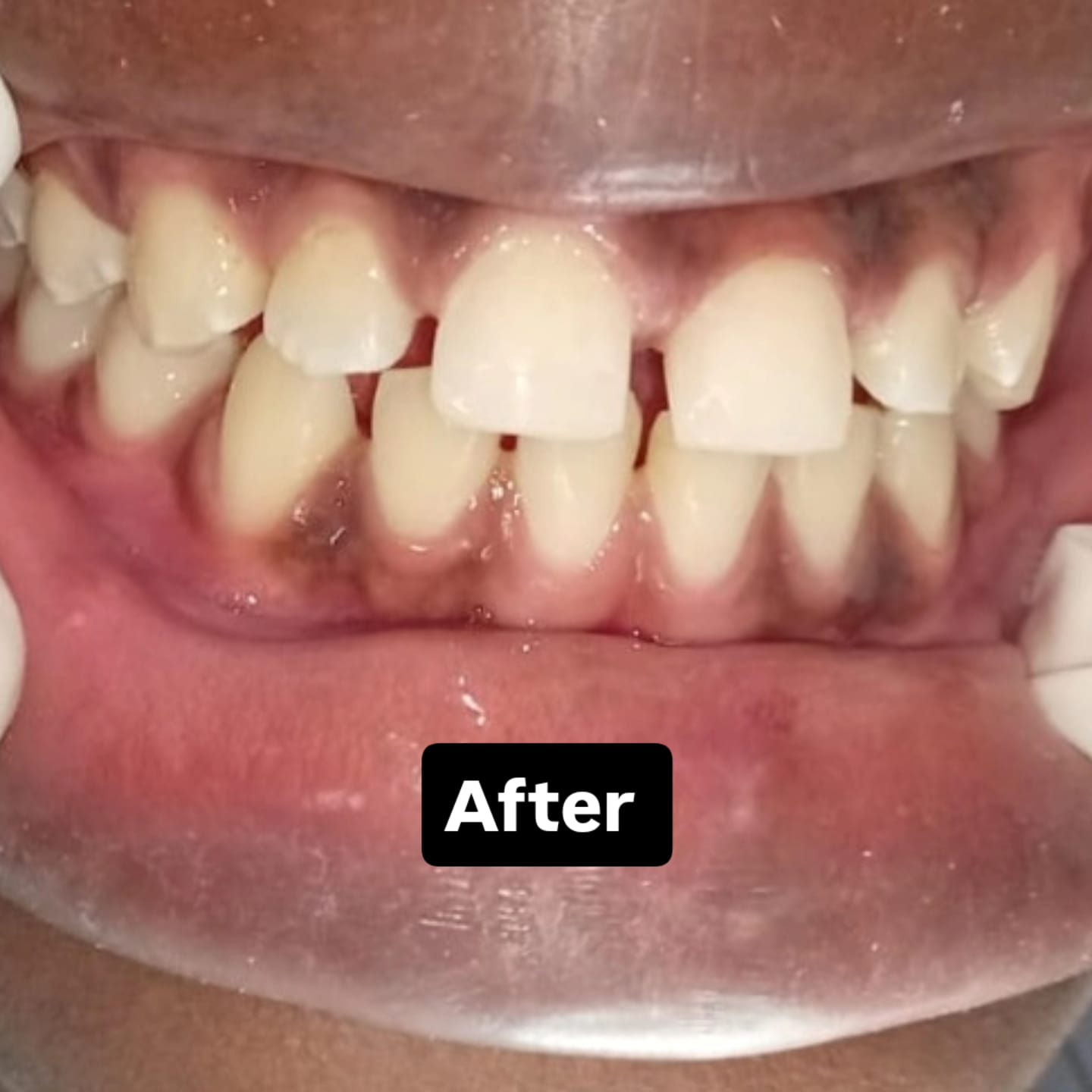 Smile after restorative dental treatment