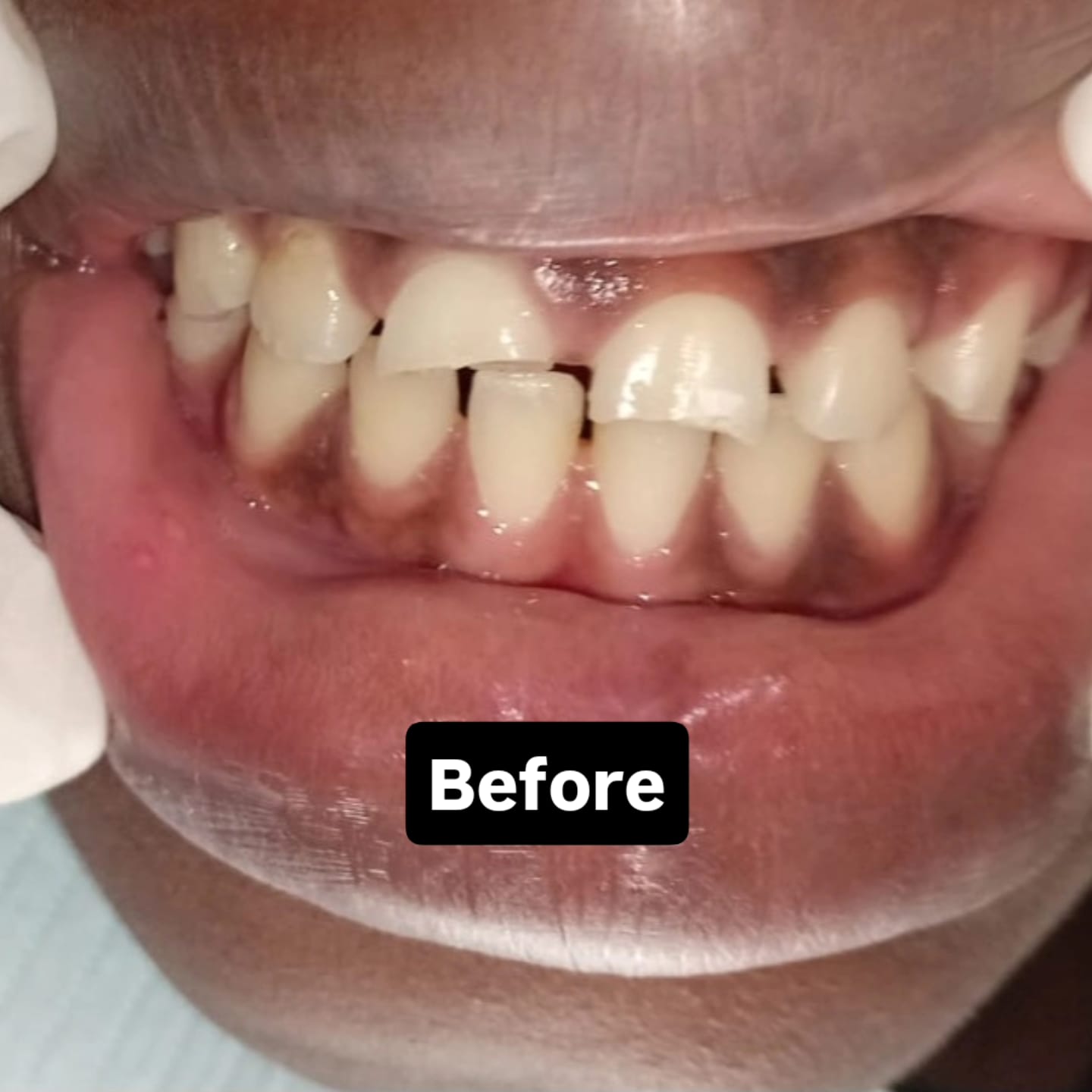 Smile before restorative dental treatment